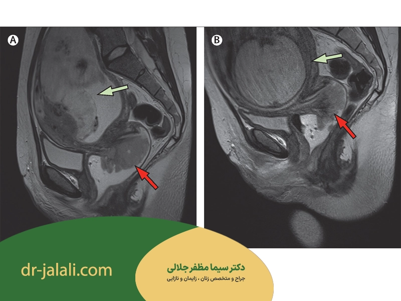 سرطان سرویکس در بارداری