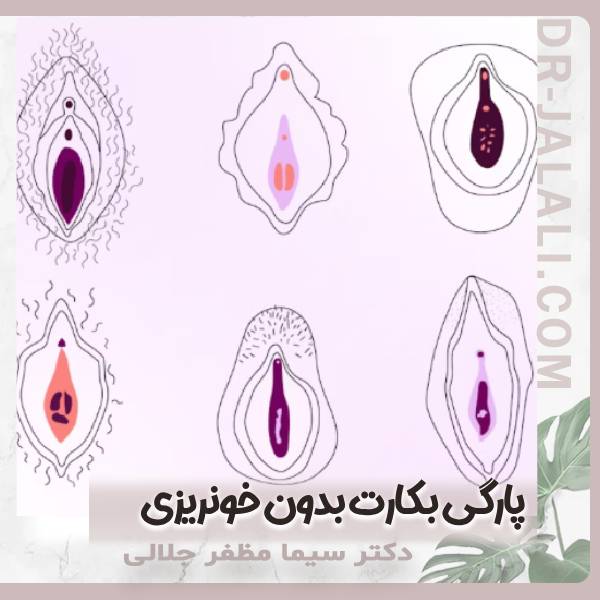 پارگی بکارت بدون خونریزی