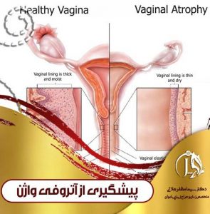 درمان آتروفی واژن با لیزر