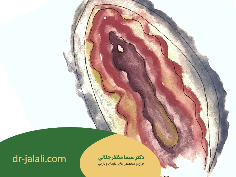 چگونگی انجام عمل واژینوپلاستی