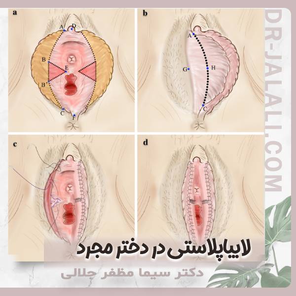 لابیاپلاستی در دختر مجرد