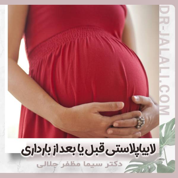 لابیاپلاستی در بارداری