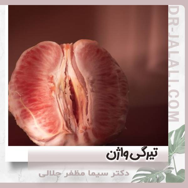 تیرگی واژن