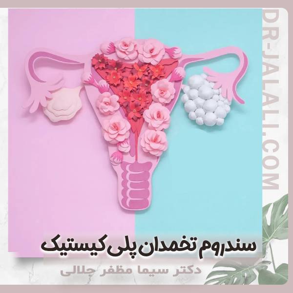 سندروم تخمدان پلی کیستیک
