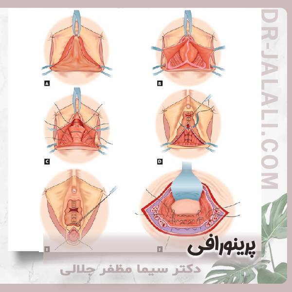 عکس عمل پرینورافی