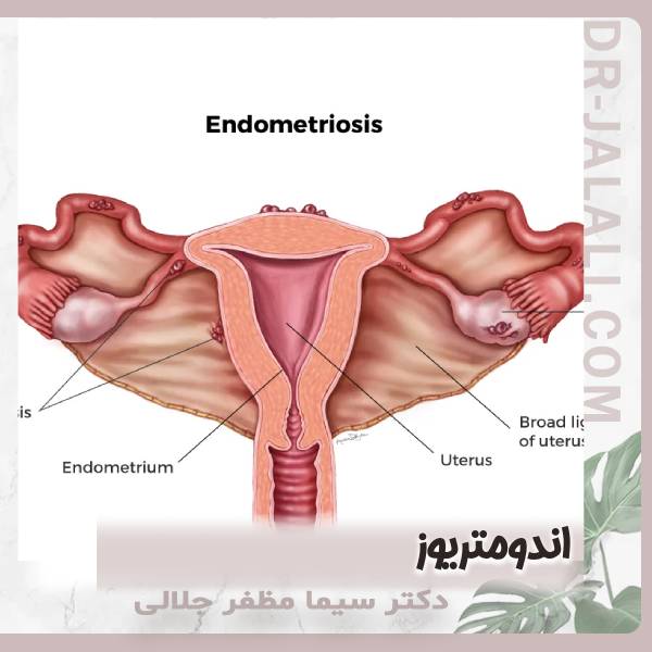 اندومتریوز