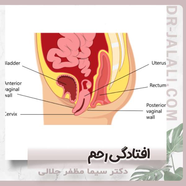افتادگی رحم