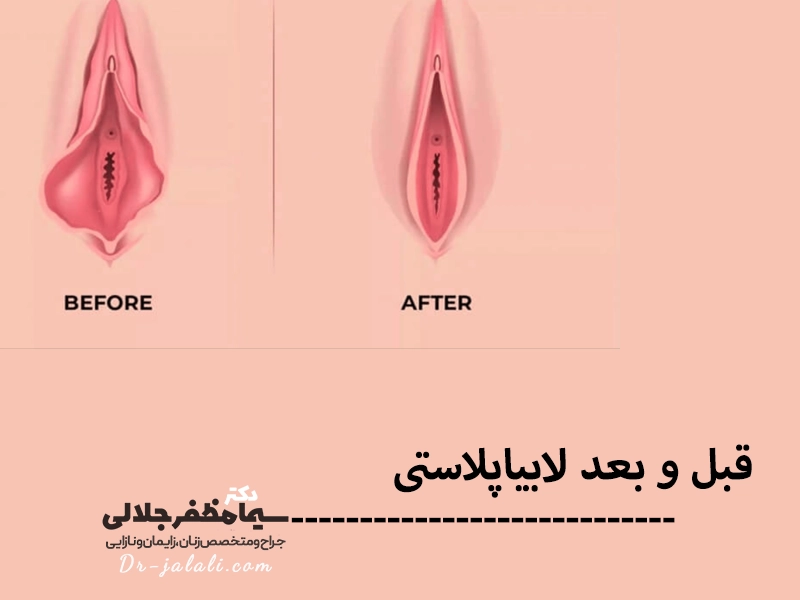 قبل و بعد لابیاپلاستی