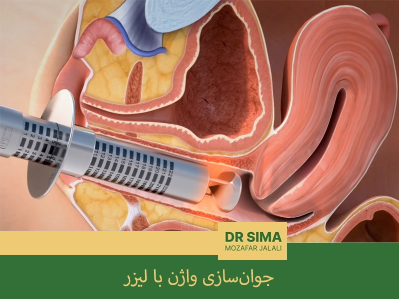 جوان‌سازی واژن با لیزر