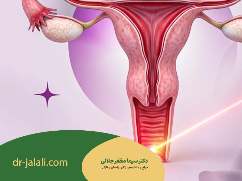 لیزر واژینوپلاستی