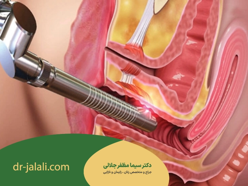 کاربردهای تنگ کردن واژن با لیزر