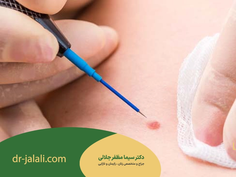 الکتروکوآگولاسیون زگیل تناسلی