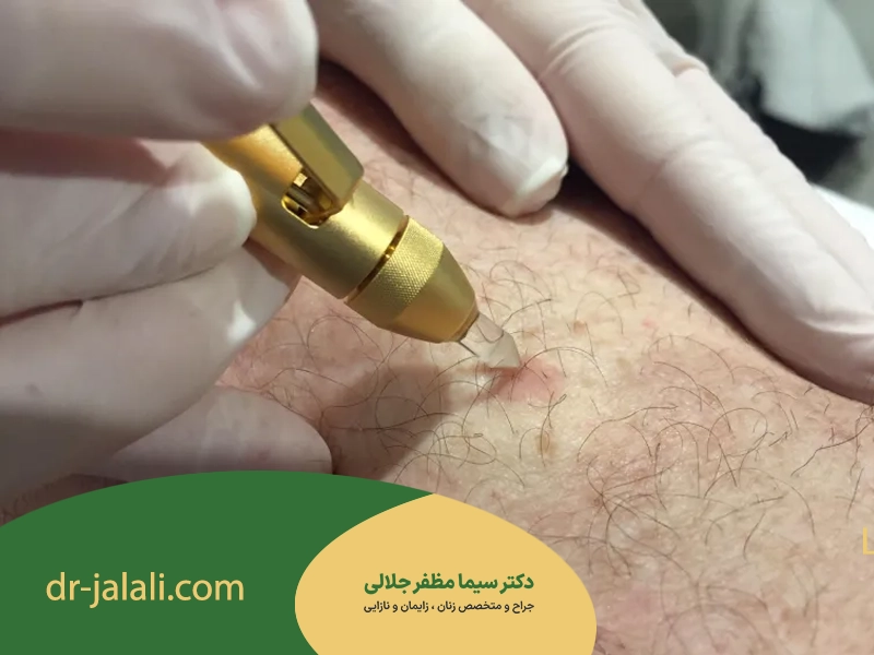 درمان زگیل تناسلی با کرایوتراپی