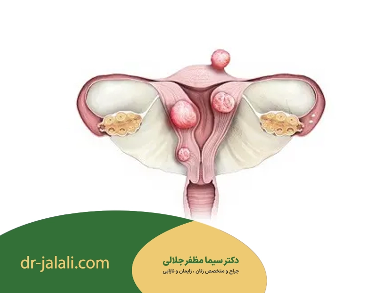  انواع شایع توده‌های لگنی
