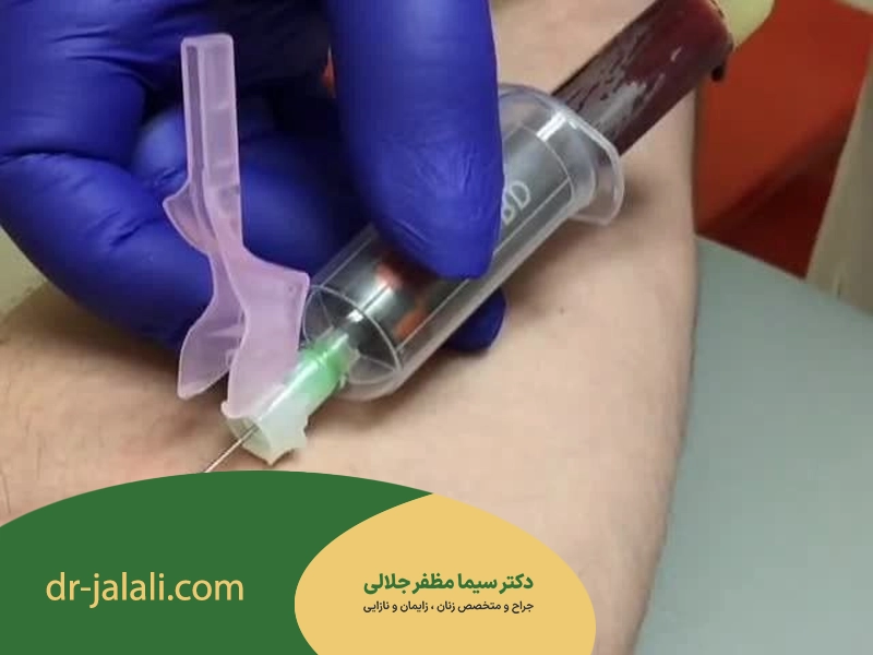 اقدامات قبل از لابیاپلاستی