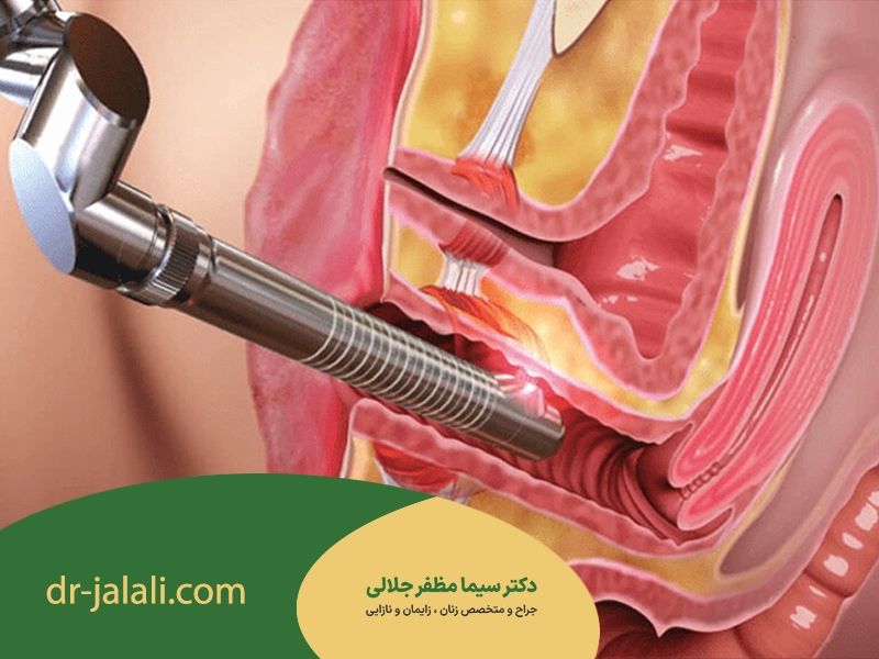 جراحی تنگی واژن